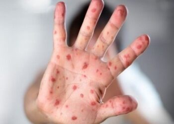 Casos de Síndrome Mão-Pé-Boca crescem em Souto Soares