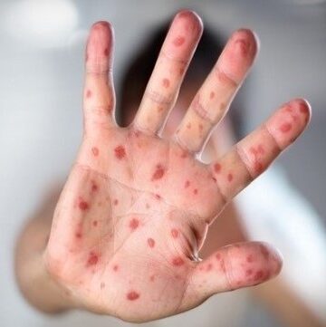 Casos de Síndrome Mão-Pé-Boca crescem em Souto Soares